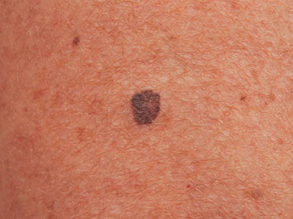 Поверхностно-распространяющаяся меланома Злокачественная поверхностно-распространяющаяся меланома