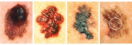 Перерождение родинки в меланому Настораживающие изменения родинки