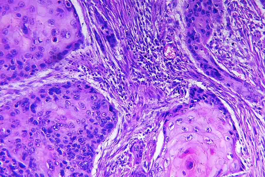 Клиническая картина плоскоклеточного рака желудка