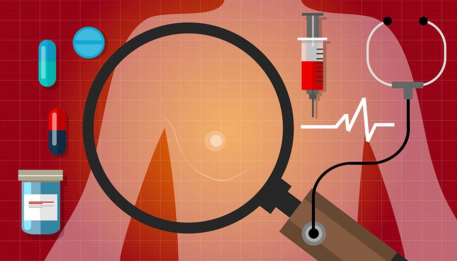 Трижды негативный рак молочной железы Трижды негативный рак молочной железы