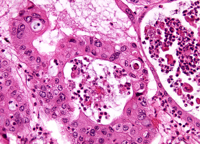 Гистология метастазов рака в печени