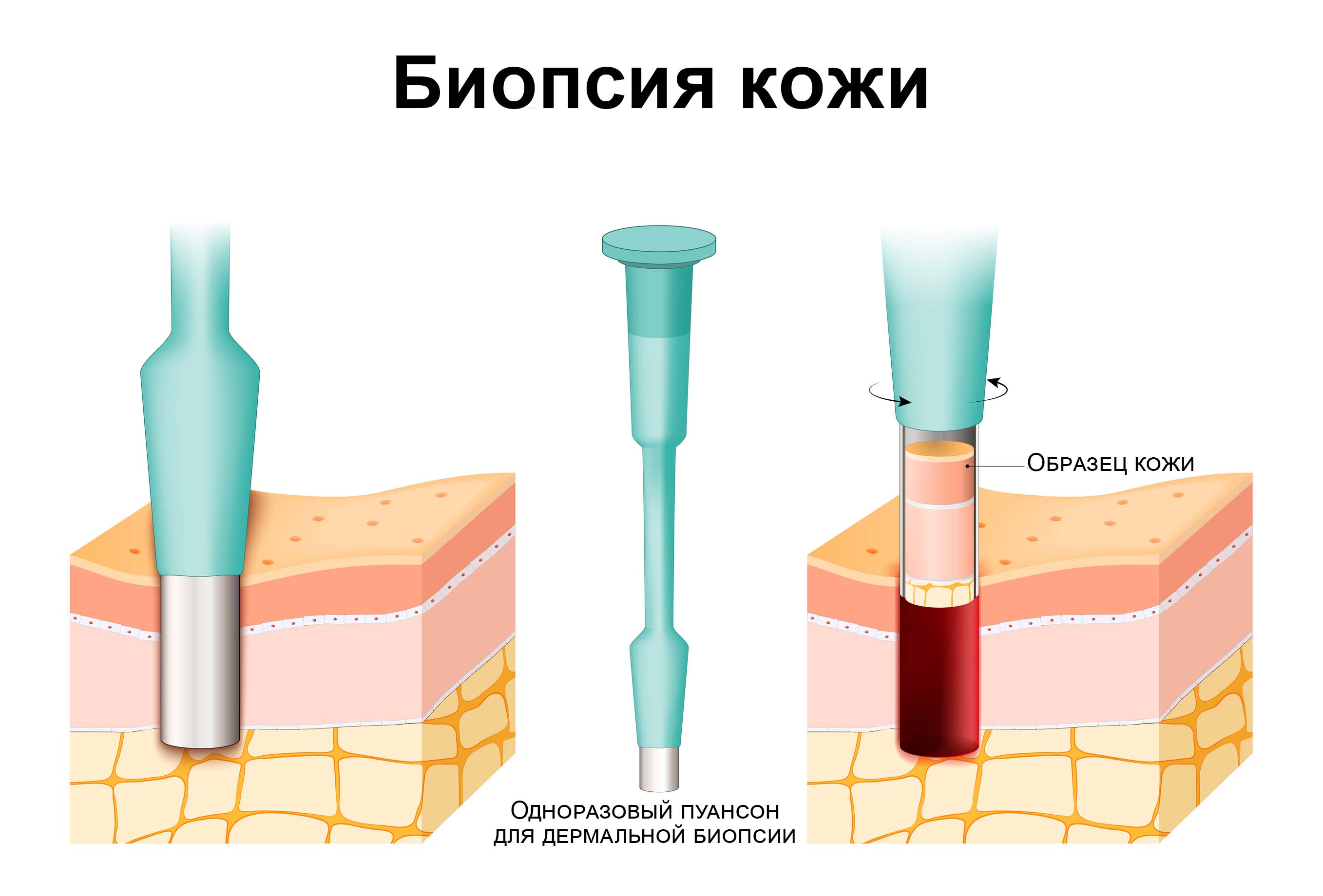 Биопсия кожи. Эксцизионная биопсия кожи.