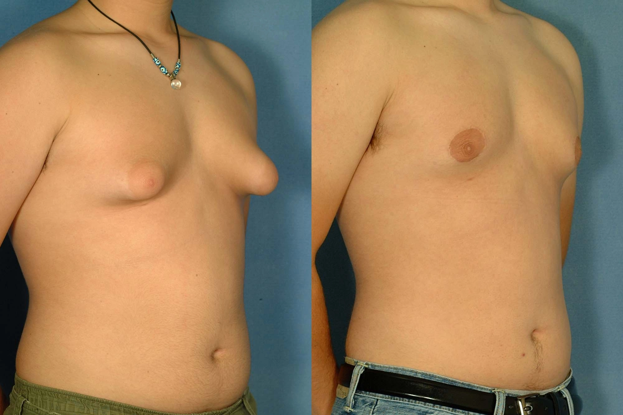 изменение груди у мужчин фото 67