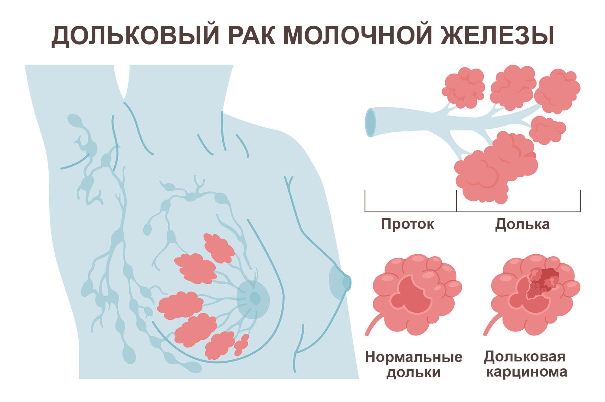 доброкачественные опухоли в груди у женщин фото 41