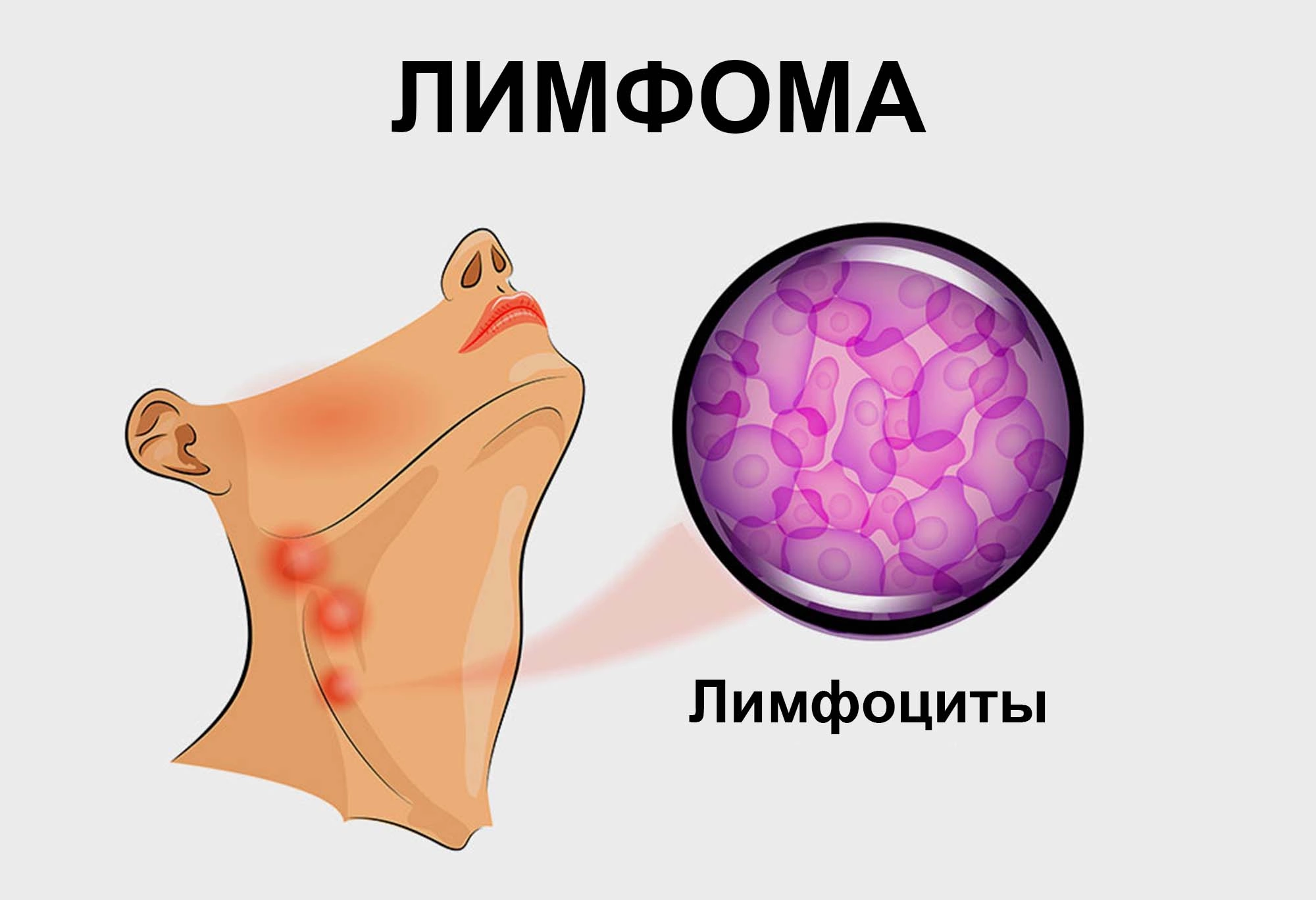 Заболевание лимфома