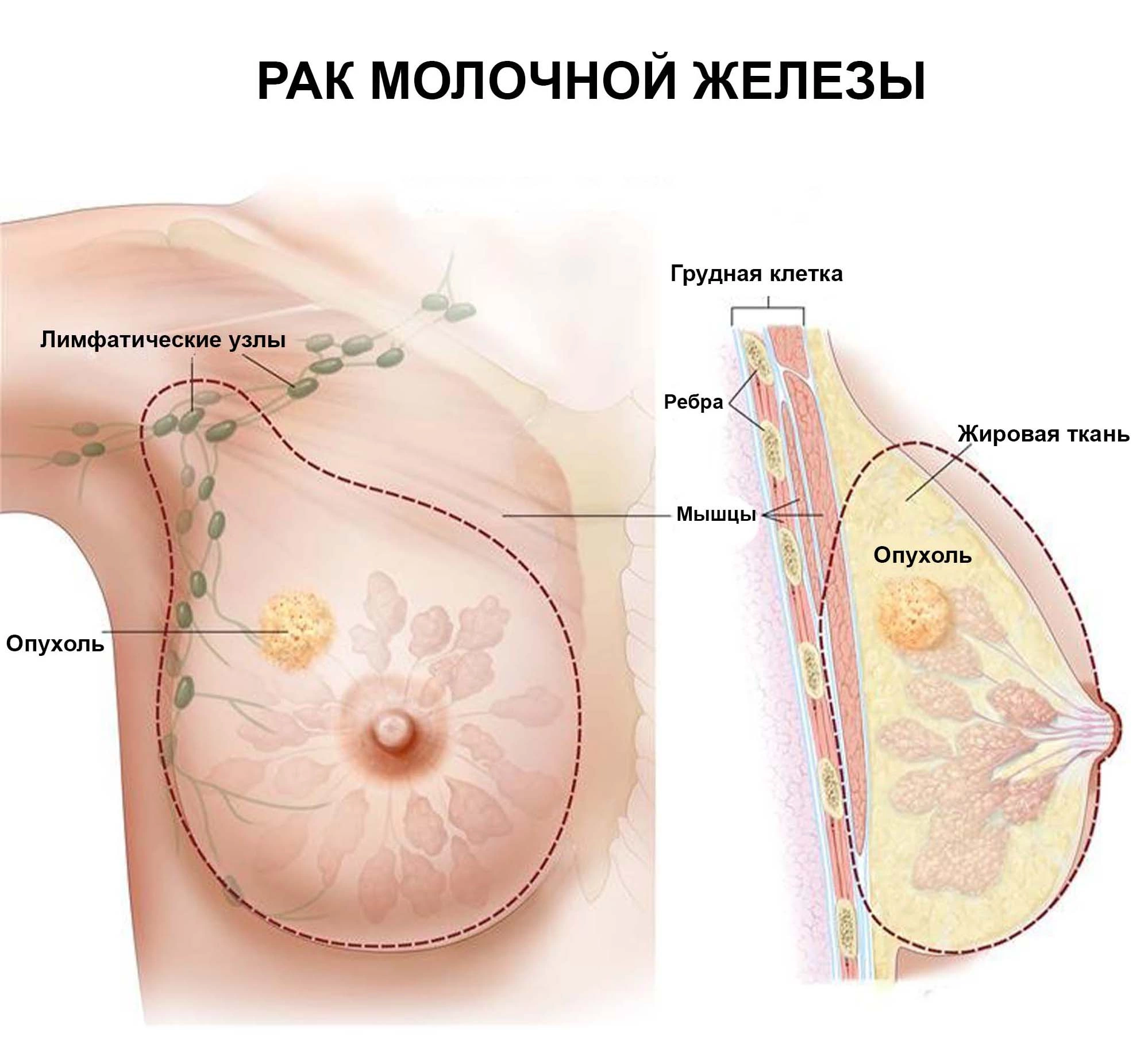 Онкология молочной железы у женщин и мужчин: виды и симптомы онкозаболеваний, причины, прогнозы, методы диагностики и лечения