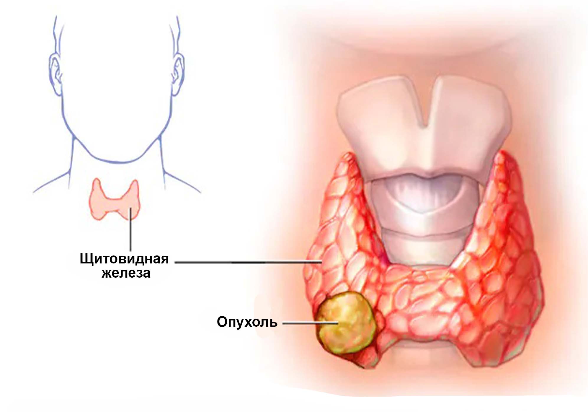 Щитовидная железа опухоль. Гипопаратиреоз щитовидной железы. Карцинома щитовидной железы. Тумор щитовидной железы. Перешеек щитовидной железы.