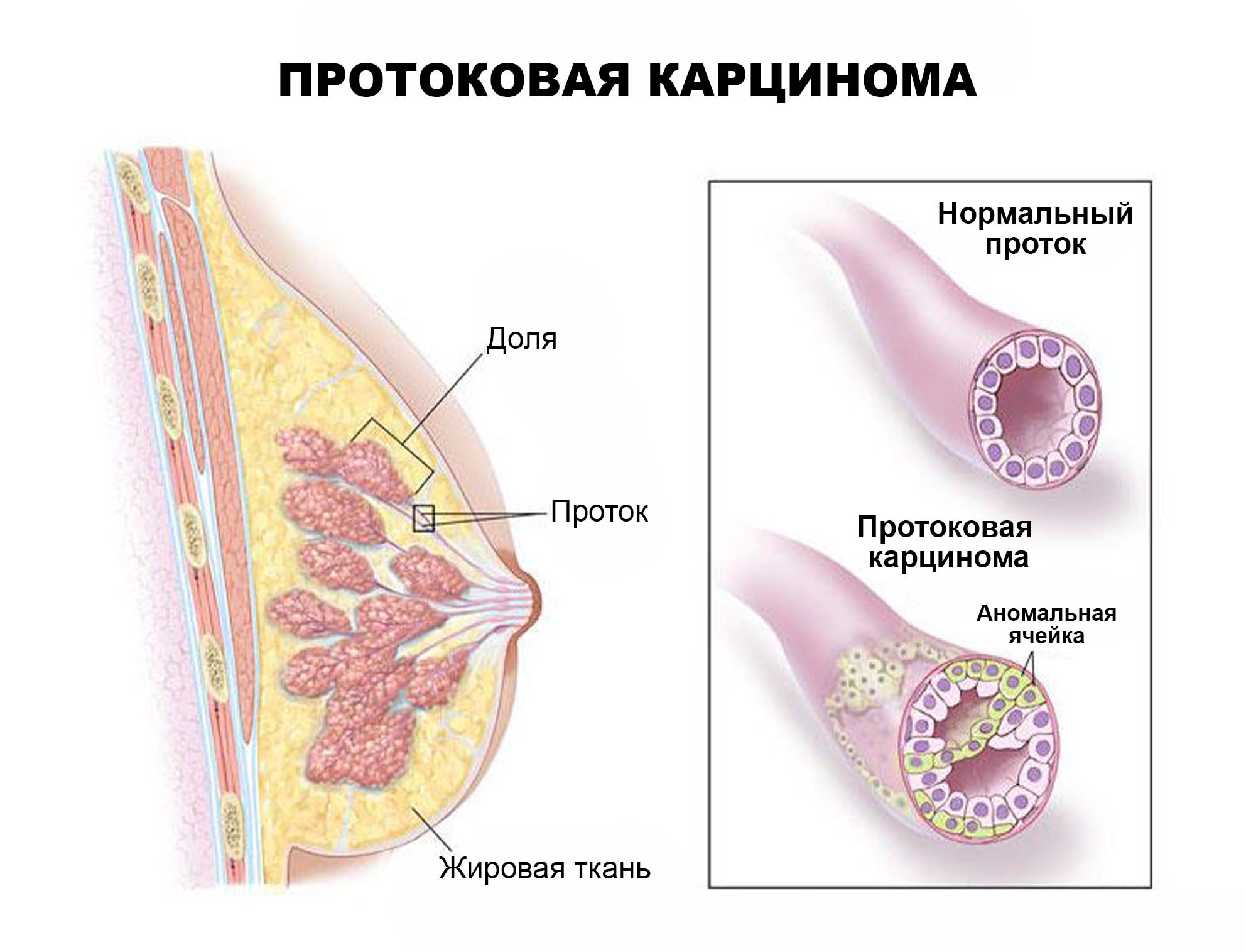 симптомы рака груди у женщин признаки фото 108