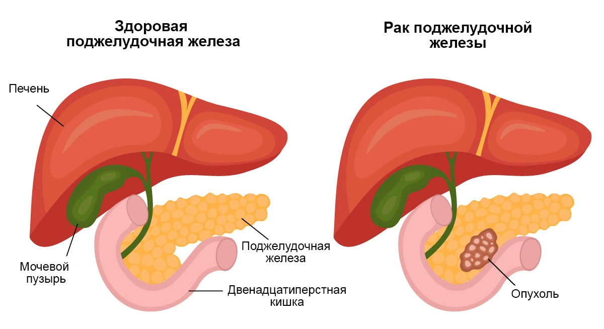 Панкреатит стул со слизью