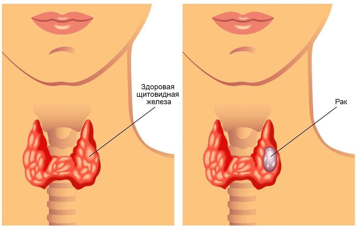 Рак щитовидной железы: симптомы, прогноз, виды, стадии, диагностика и  лечение онкологии щитовидки