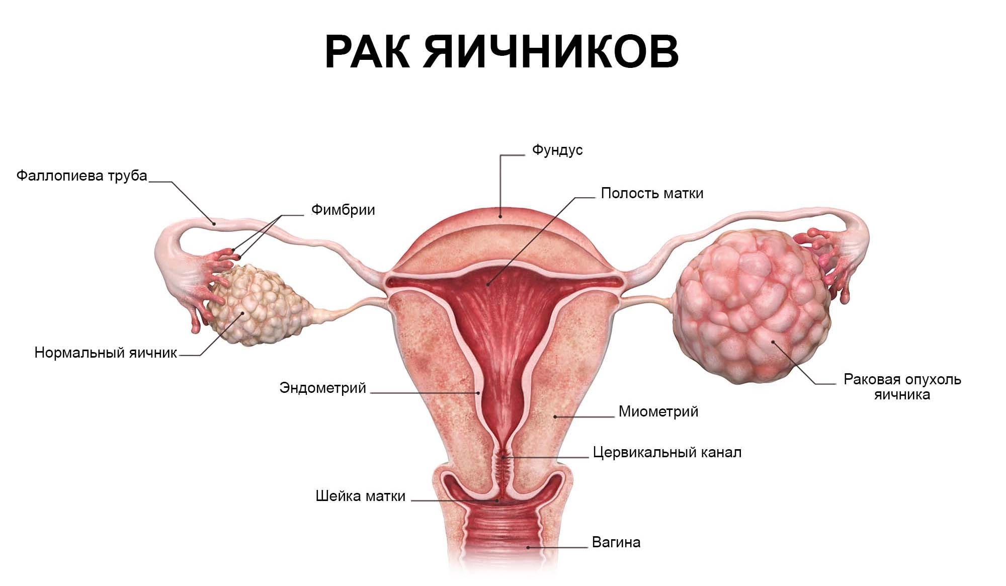 Рак яичников: симптомы и признаки, стадии, прогноз, причины, классификация,  диагностика и лечение онкологии яичников у женщин