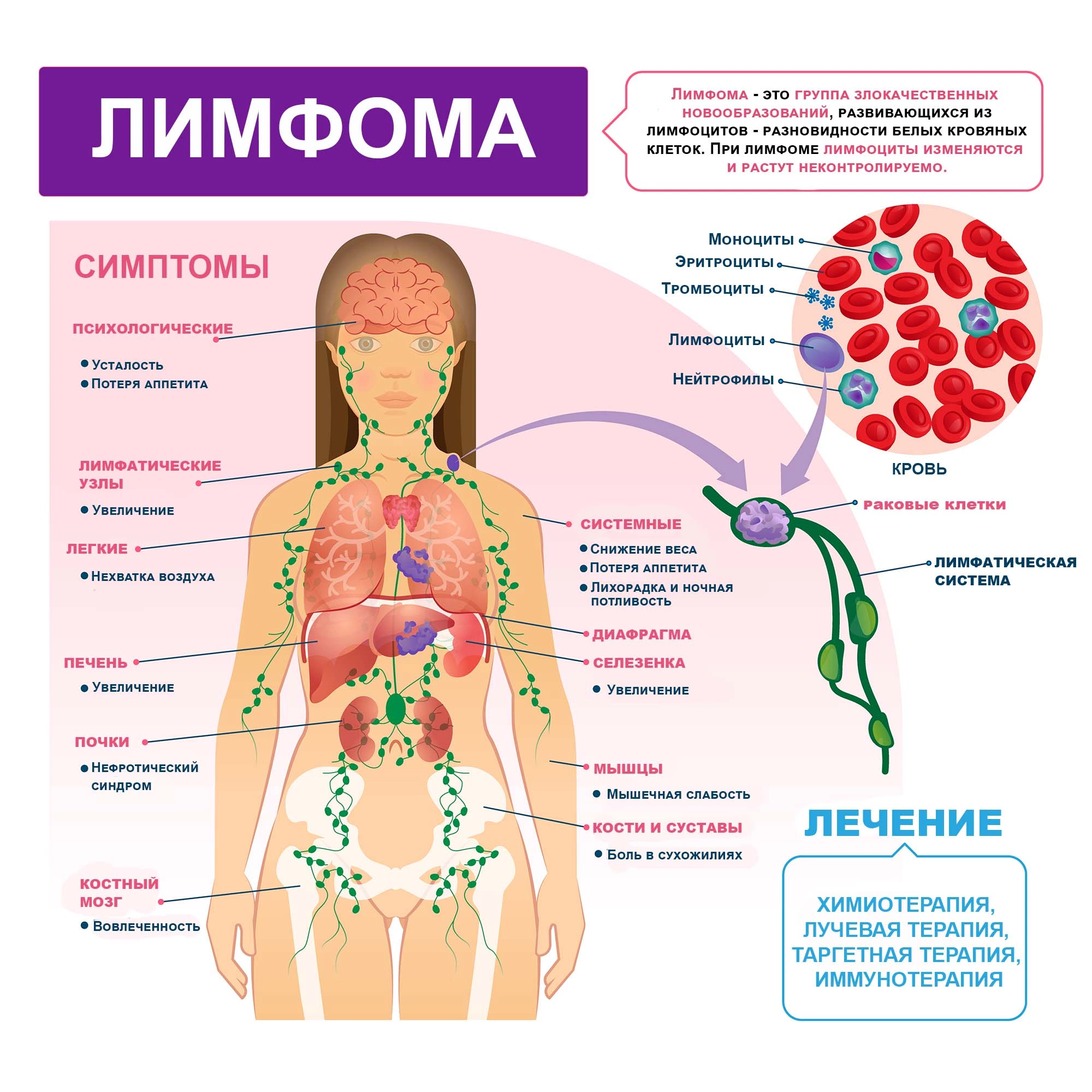 Лимфома: симптомы и признаки, стадии, прогноз, классификация, причины,  диагностика и лечение лимфом