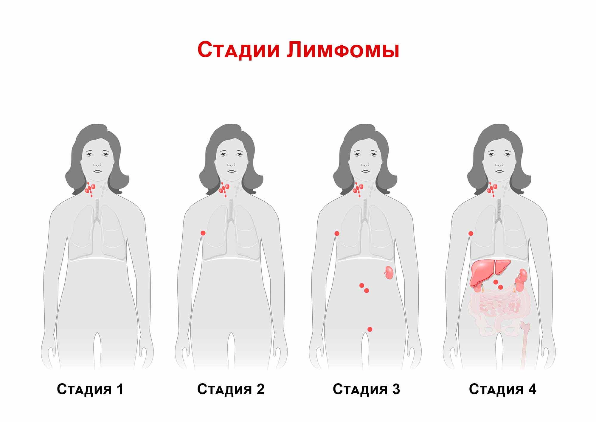 Стадии заболевания лимфома