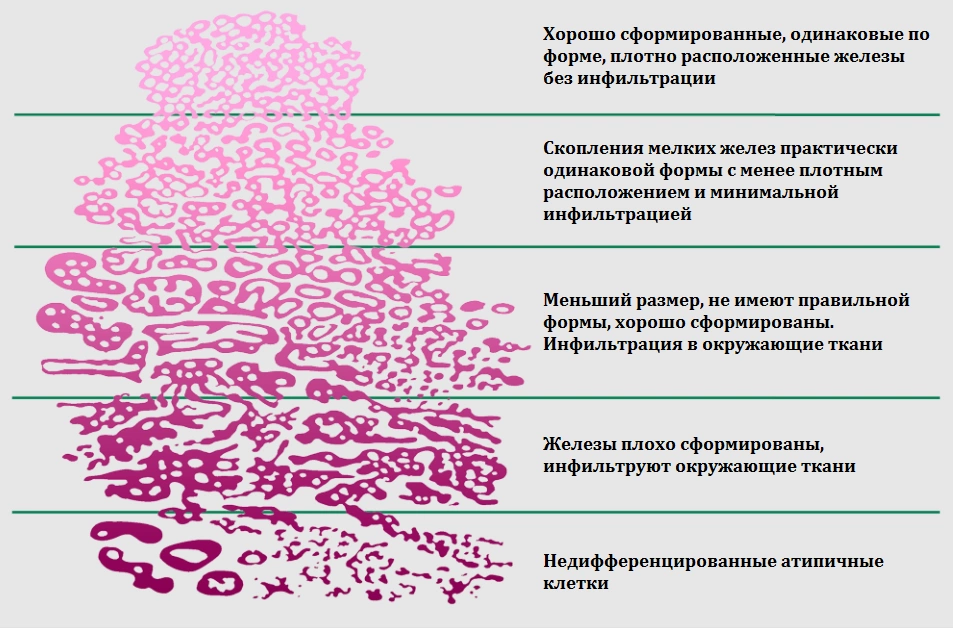 Увеличение предстательной железы у мужчин причины. Ацинарная аденокарцинома предстательной железы 6 баллов по глисону 3+3. Оценка по глиссону. Предстательная железа Глисон.