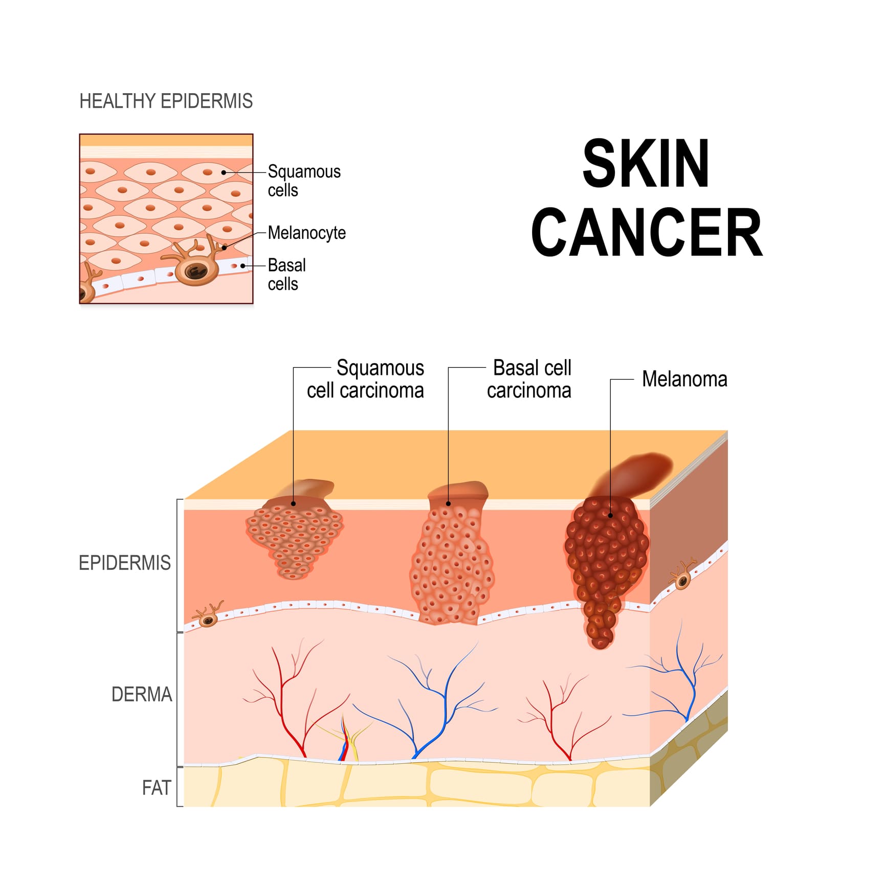 Рак кожи