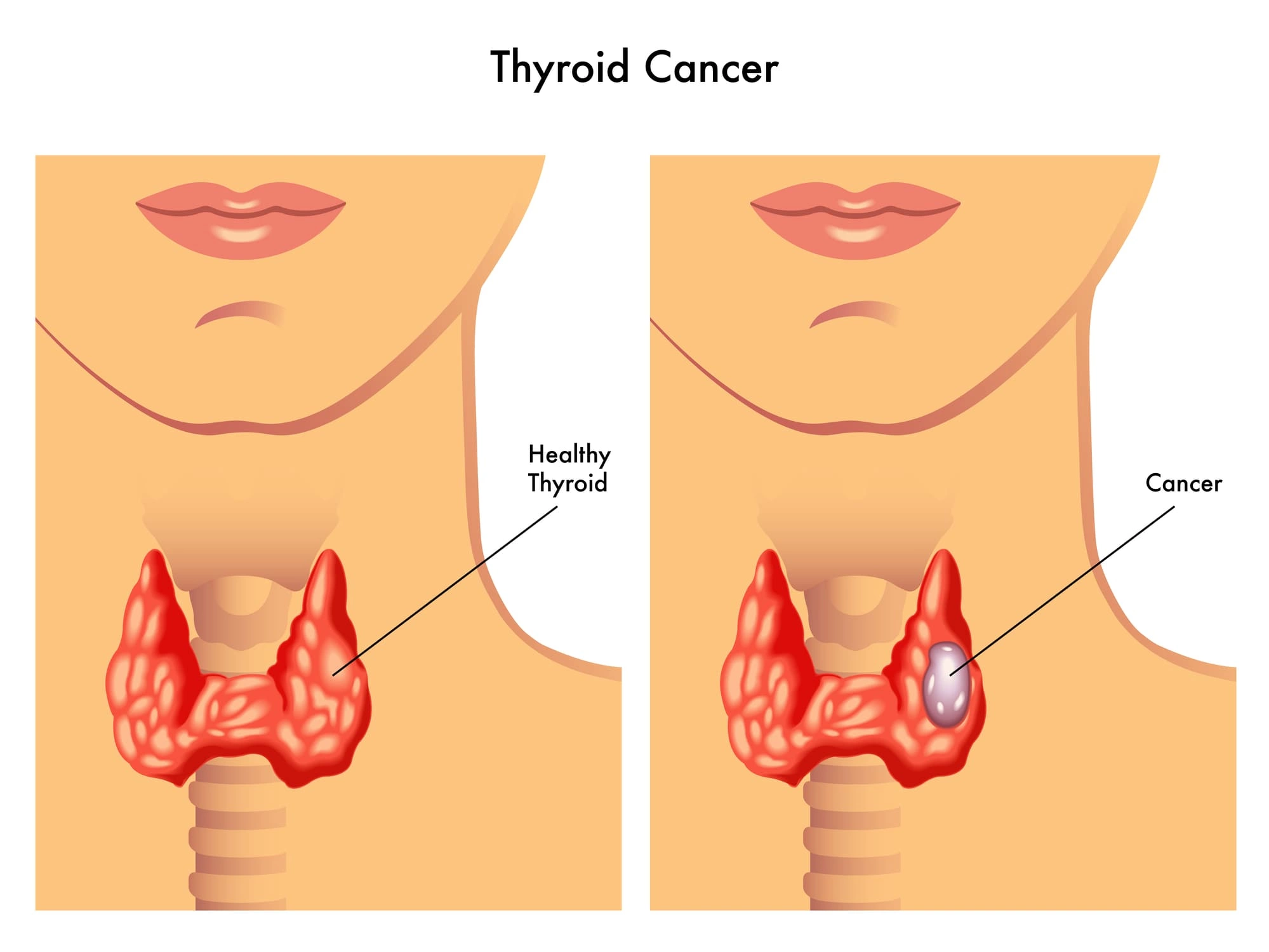 Узлы щитовидной железы - причины, классификация, симптомы, размеры, диагностика, лечение