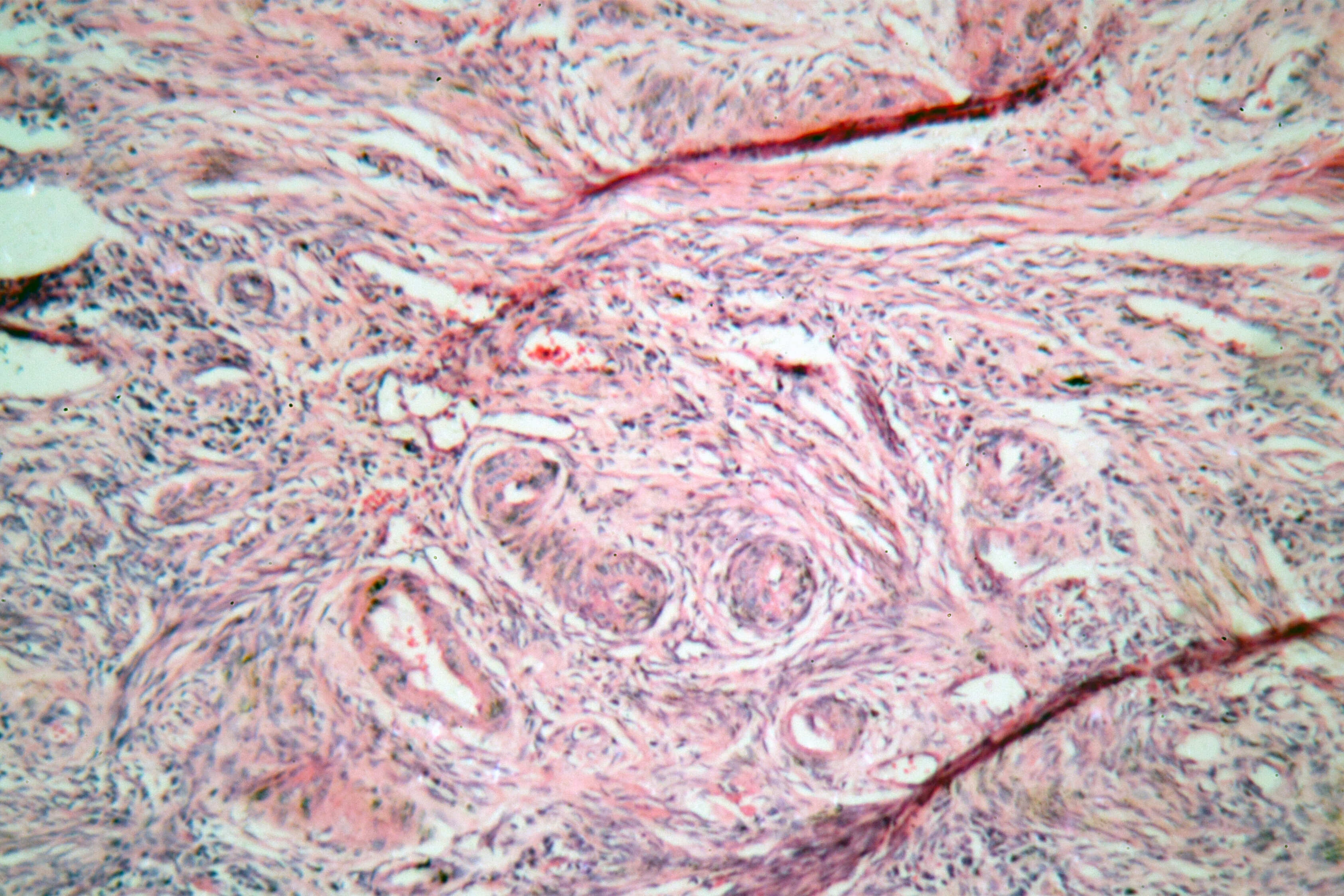 Плоскоклеточный рак шейки матки неороговевающего типа