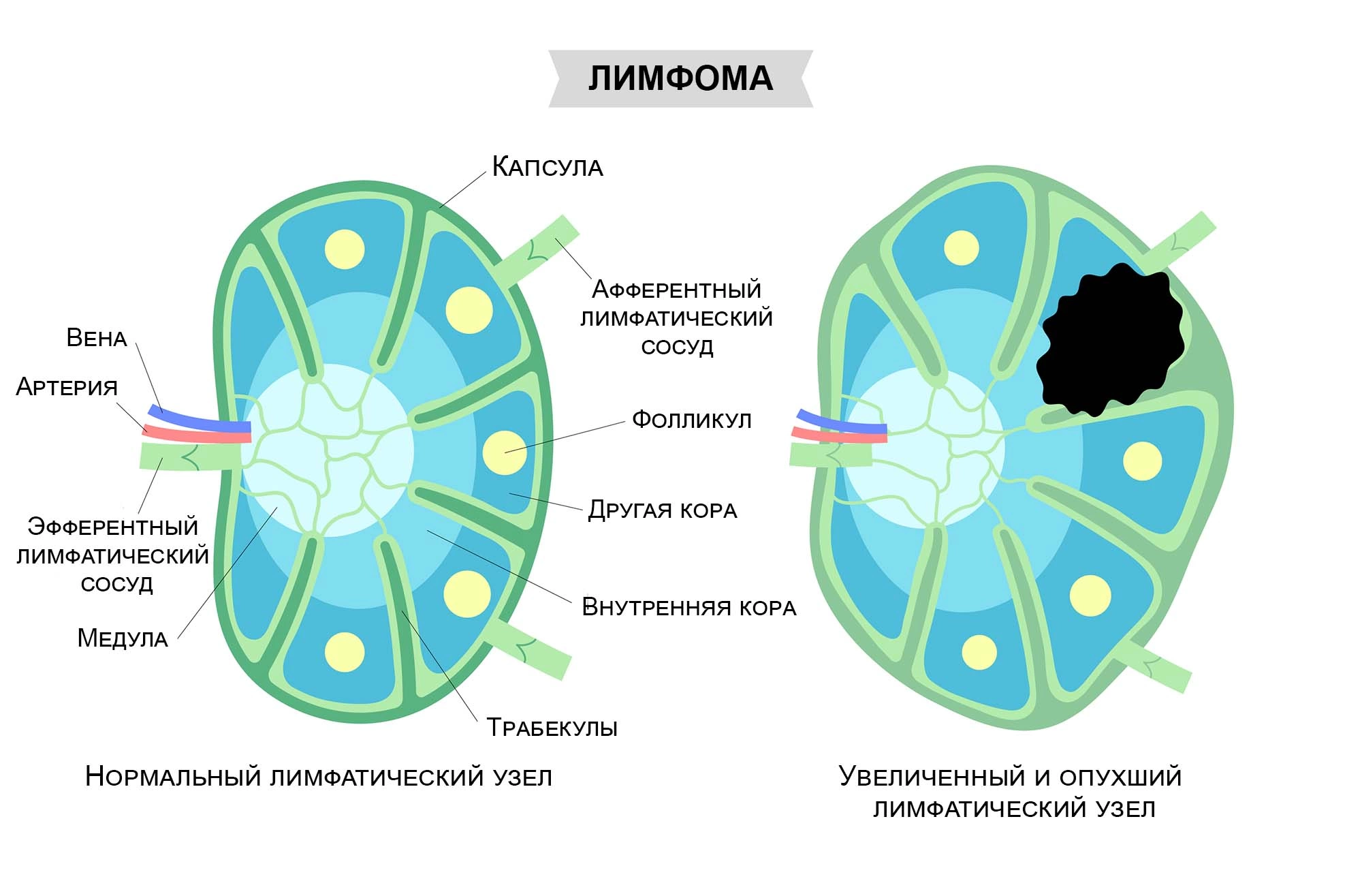 Лимфостаз - причины появления, при каких заболеваниях возникает, диагностика и способы лечения