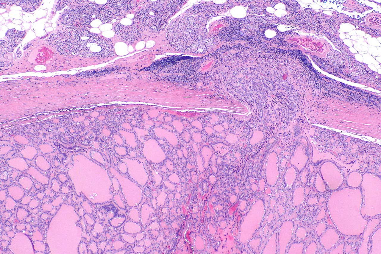 Микрофотография фолликулярной карциномы щитовидной железы