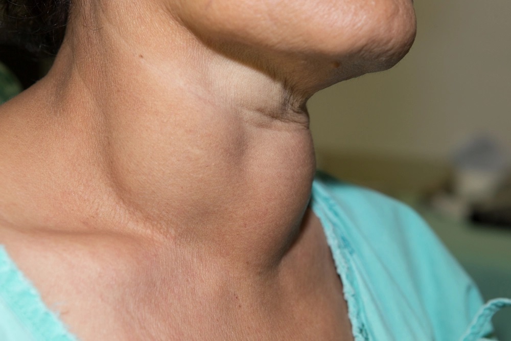 Рак щитовидной железы симптомы