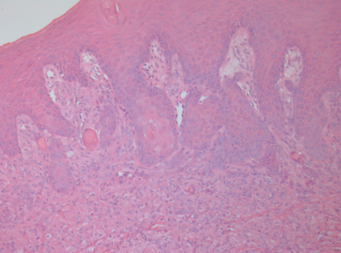 Гистологическая картина плоскоклеточного рака языка