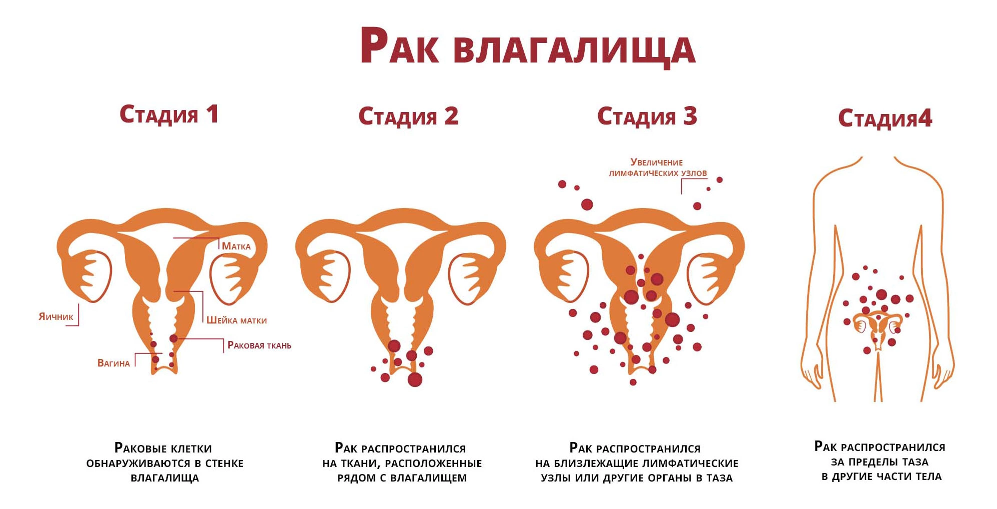 Рак влагалища стадии