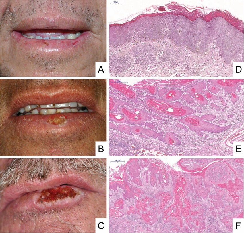 Клинические и гистопатологические особенности рака губы