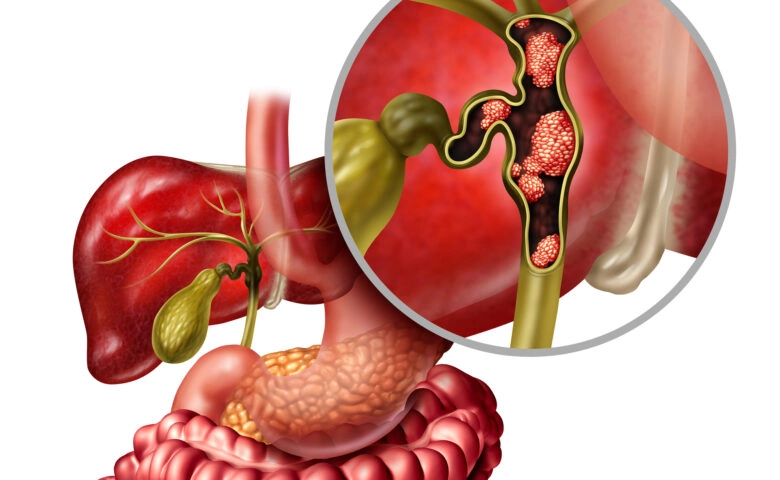 Рак желчных протоков (холангиокарцинома): симптомы, прогноз, причины ...