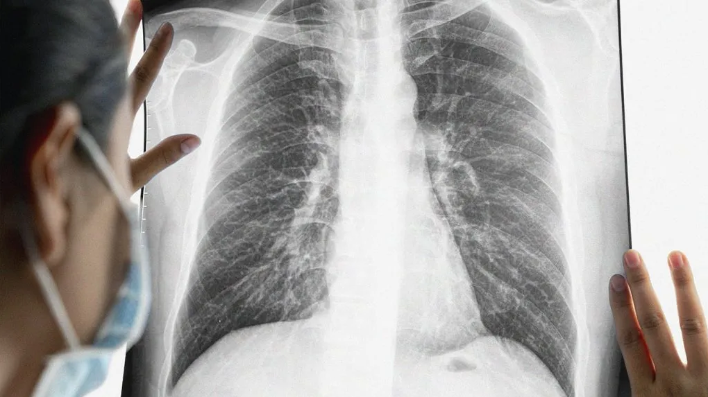 Рентгенографические признаки рака легких