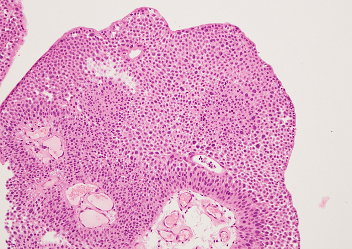 Гистологическая картина поверхностной опухоли мочевого пузыря