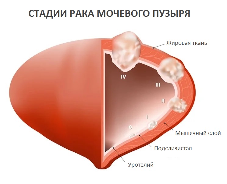 Стадии рака мочевого пузыря