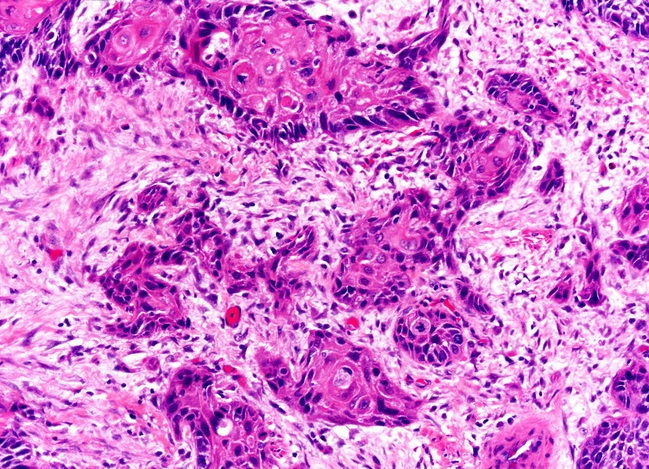 Микрофотография высокодифференцированного плоскоклеточного рака пищевода