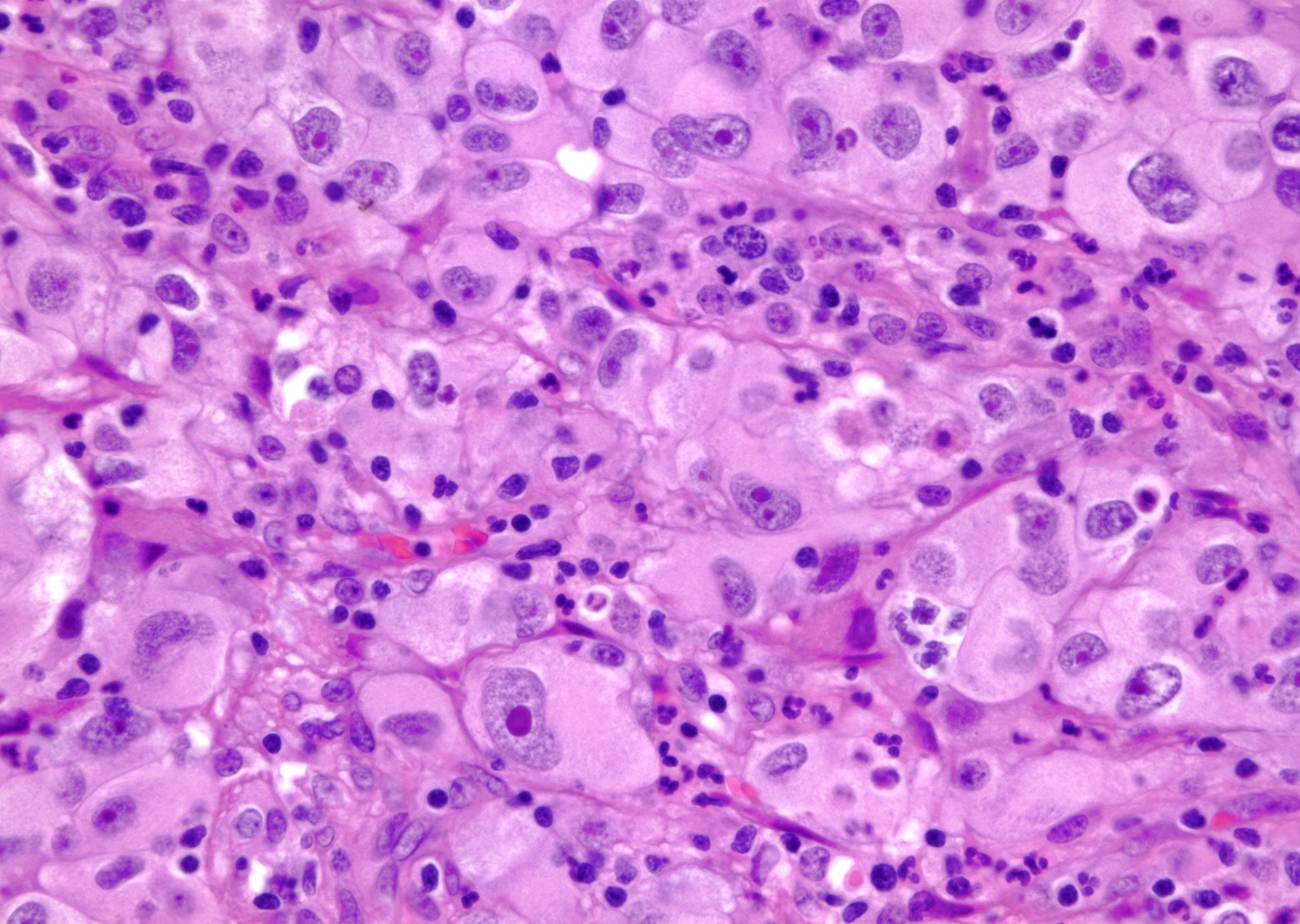 Светлоклеточный почечно-клеточный рак