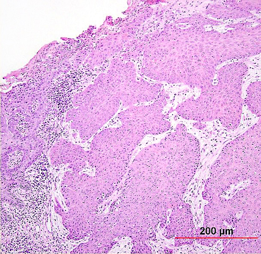 Плоскоклеточный рак шейки матки неороговевающего типа
